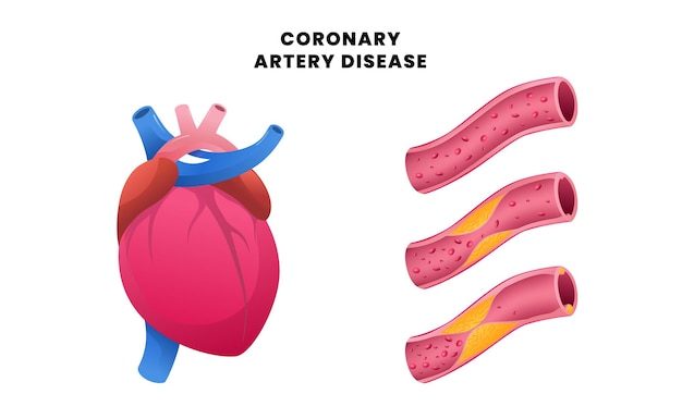 Vector coronary artery disease with heart cardiac with vein artery with normal and plaque for healthcare cardiovascular