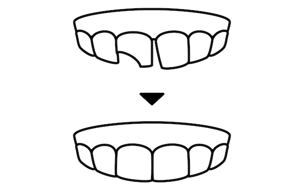 Vector cosmetic dentistry direct bonding before and after simple line drawing