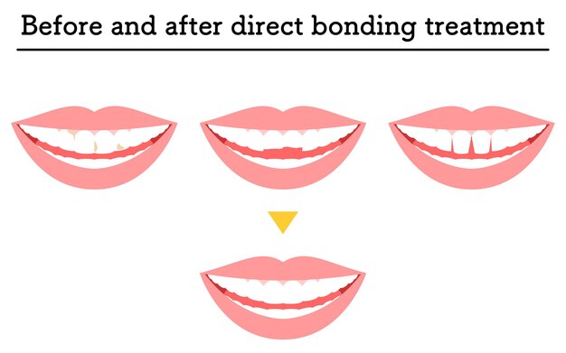 Vector cosmetic dentistry treatment with direct bonding decayed or chipped teeth and gaps