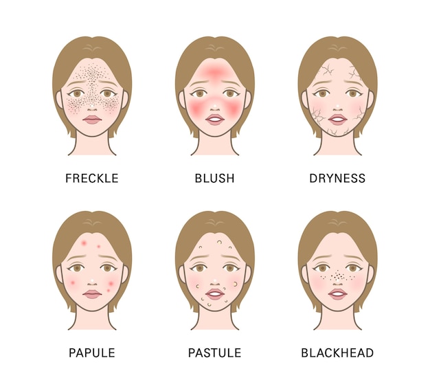 Cosmetic skin trouble_woman with freckle blush dryness papule pastule blackhead