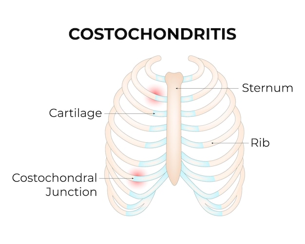 Vector costochondritis cartilage sternum rib costochondritis junction vector illustration