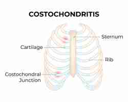 Vector costochondritis cartilage sternum rib costochondritis junction vector illustration