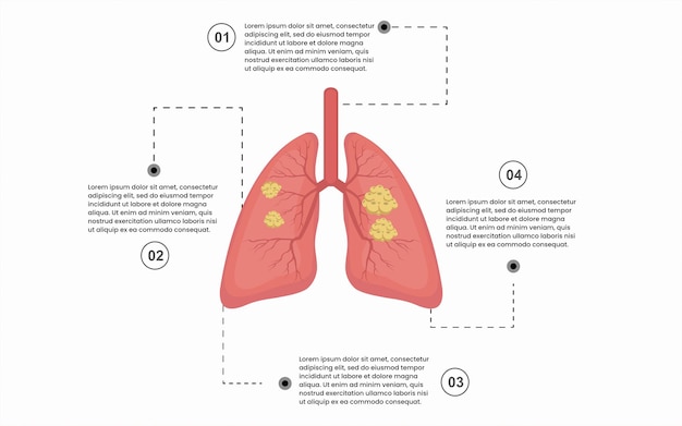 Creatieve infographic-sjabloon voor teken bij longziekten met 4 opties, onderdelen, stappen of punten.