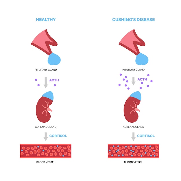 Vector cushing syndrome disease vector illustration cortisol in adrenal gland increased secretion of acth