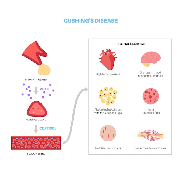 Cushing syndrome disease vector illustration cortisol in adrenal gland increased secretion of acth