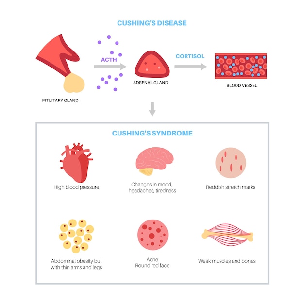 Vector cushing syndrome disease vector illustration cortisol in adrenal gland increased secretion of acth