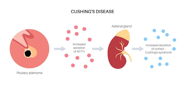 Illustrazione del vettore della malattia della sindrome di cushing cortisolo nella ghiandola surrenale aumento della secrezione di acth