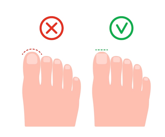 足の爪を間違って右に切るペディキュアサークルとまっすぐに切る爪陥入爪の予防