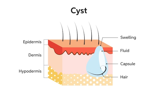 Vector cyst wall