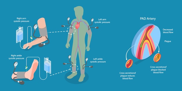 Vector d isometric flat vector illustration of abi test limb ischemia diagnosis