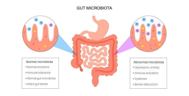 Darmhersenverbinding dysbiose en microbioom normale en abnormale microbiota