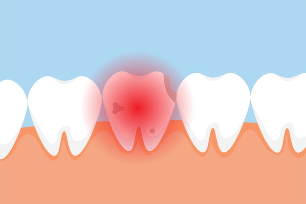 Dente morto che fa male e dà un concetto di segnale di dolore rosso un dente cattivo con cavità e un segnale di pericolo rosso vettore di elementi infografici dentali con un dente morto stomatologia cura dei denti