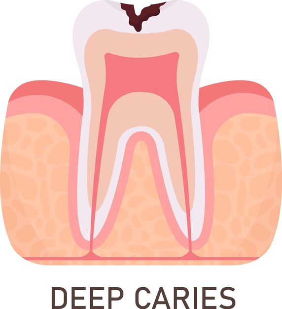 Vettore problema dei denti con carie profonda