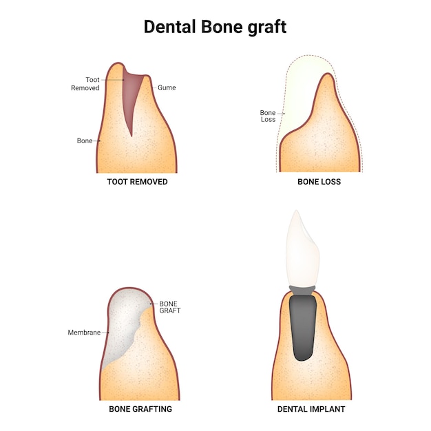 Vector dental bone graft toot removed bone loss bone grafting dental implant vector illustration