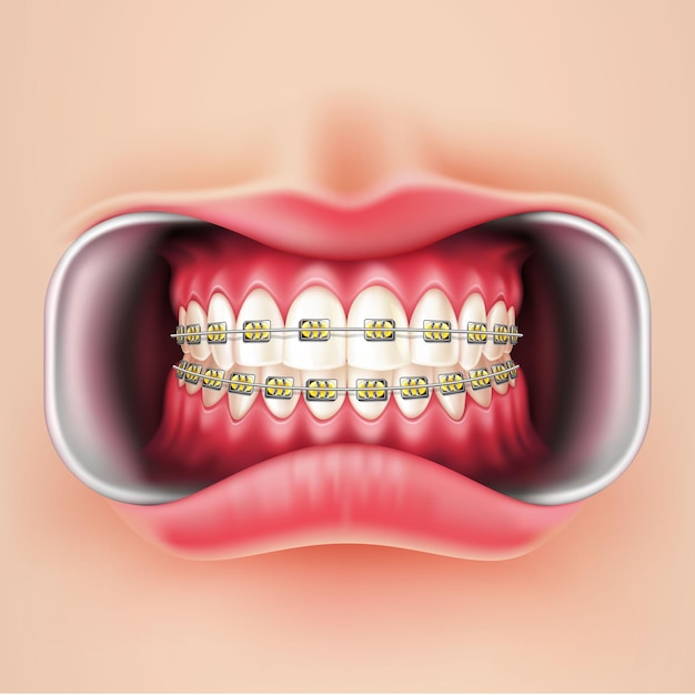 Vector dental braces installation