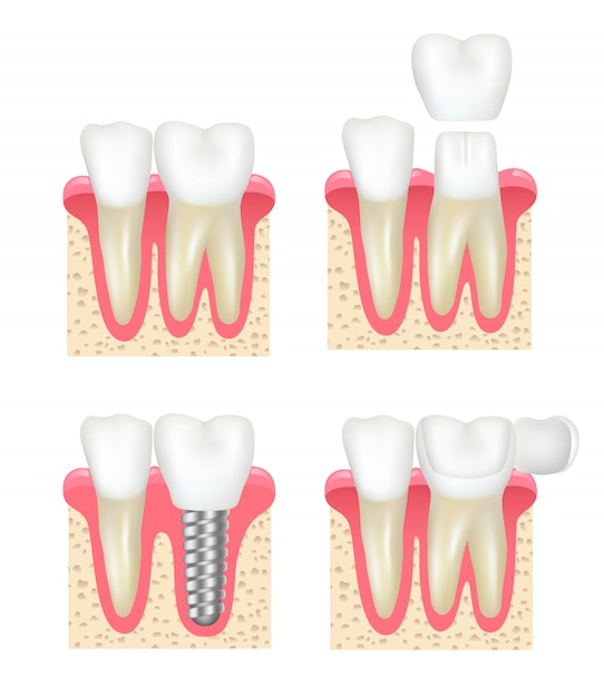 Corona dentale. collezione dentista stomatologia cavità sana impianti di impiallacciatura del dente