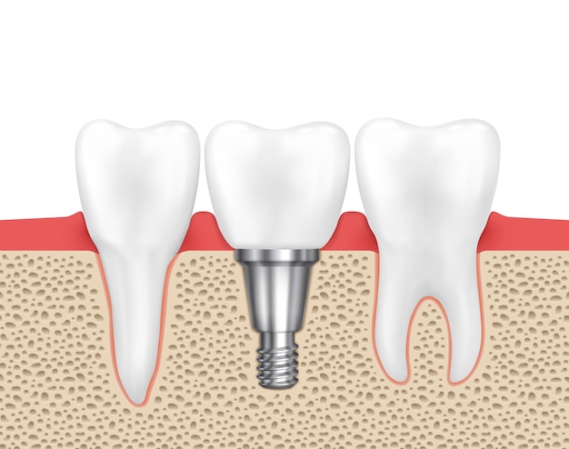 Vector dental human implant. medical human dental, implant dental, dentistry implant tooth, dental inplant vector illustration