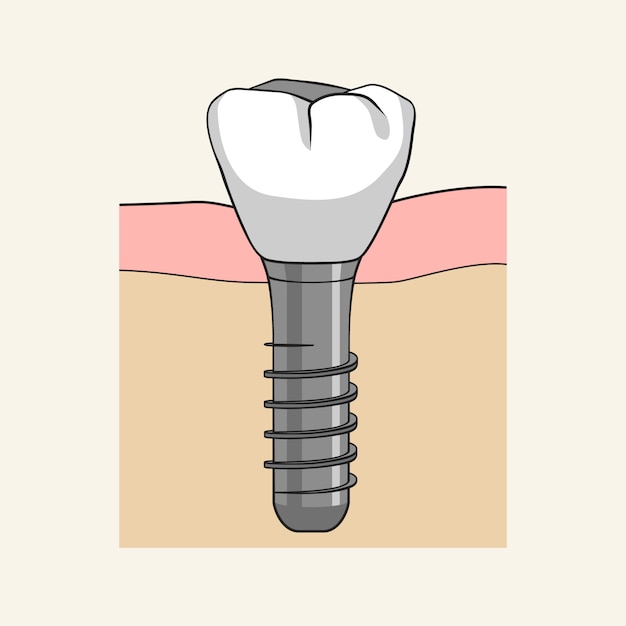 Dental implant closeup