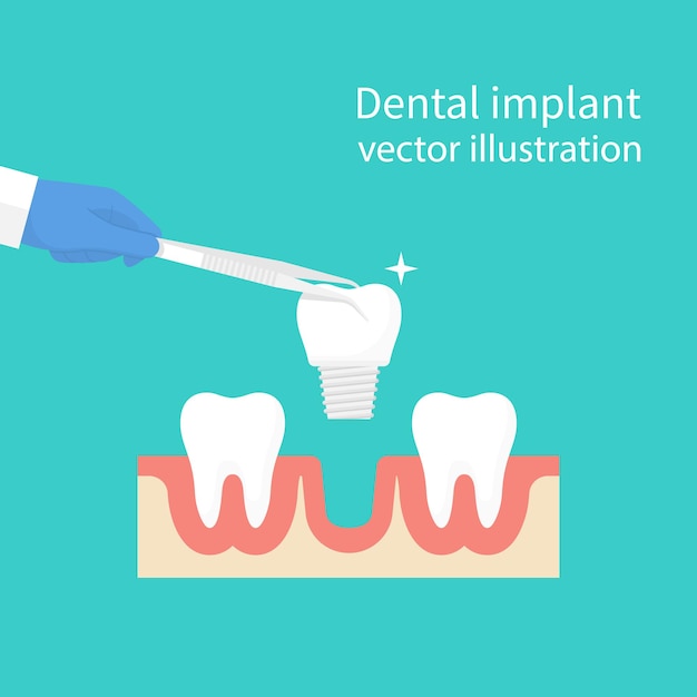 Impianto dentale. dentista che tiene in mano pinzette di dentiere. attrezzature mediche. trattamento dei denti. design piatto illustrazione vettoriale. isolato su sfondo. concetto di stomatologia.