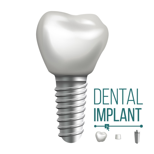 Dental Implant illustration