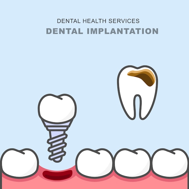 Dental implant instead of carious tooth - teeth prosthetics