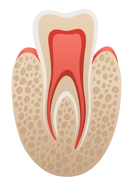 Вектор Стоматологический имплантат медицинский образовательный инфографический плакат зубный имплантат реалистичный векторный дизайн стоматологии медицинский стоматолог и ортодонт лечение