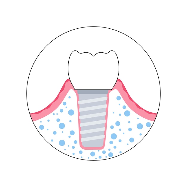 Dental implant procedure