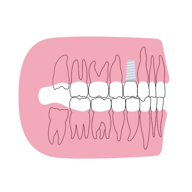 Dental implant procedure