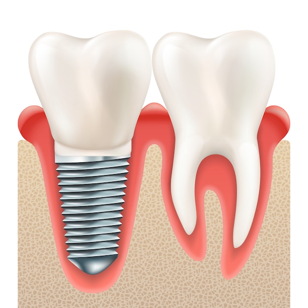 Set di impianti dentali.