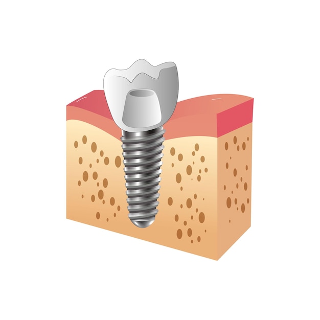 Vettore struttura dell'impianto dentale 5