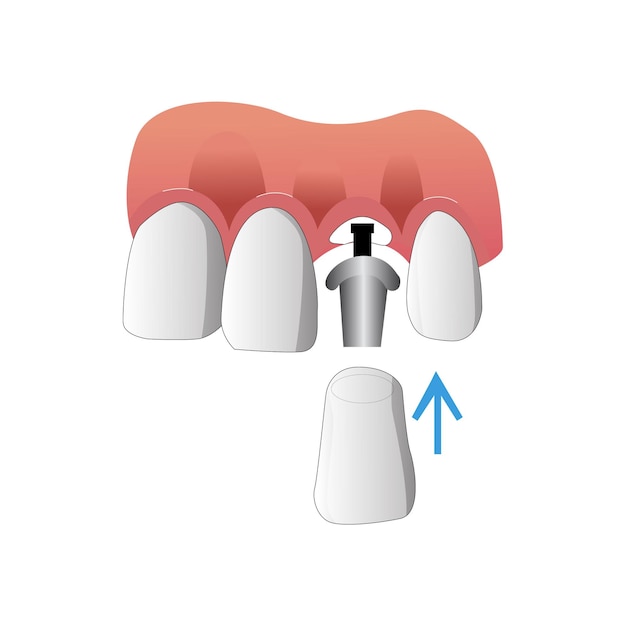 Vettore struttura dell'impianto dentale 6