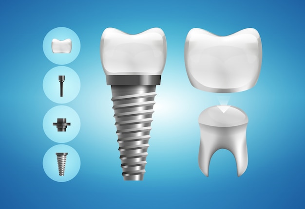 Struttura dell'impianto dentale e restauro della corona in stile realistico. .