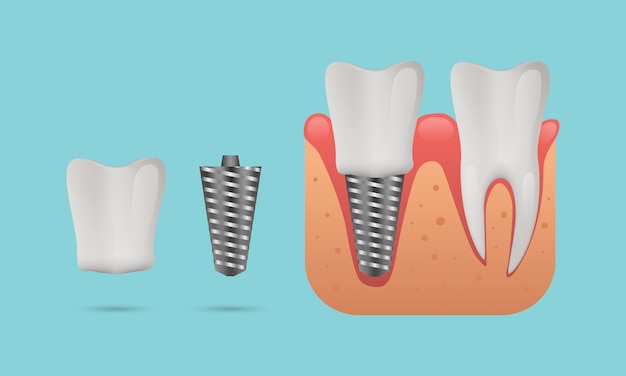 Struttura dell'impianto dentale, denti umani e impianto dentale