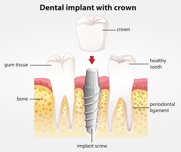 クラウンを備えた歯科インプラント