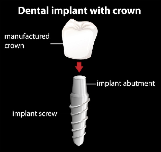 A dental implant with crown