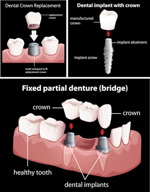 Vector dental procedures on black