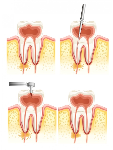 Dental root canal