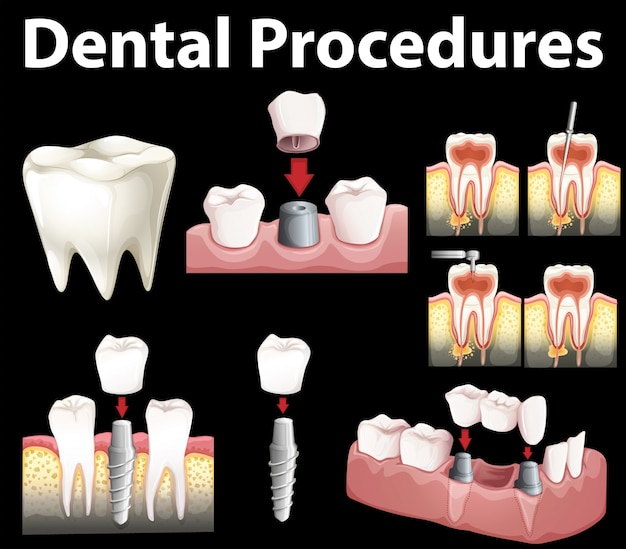 Вектор Процедуры dentale для создания иллюстрации поддельного зуба