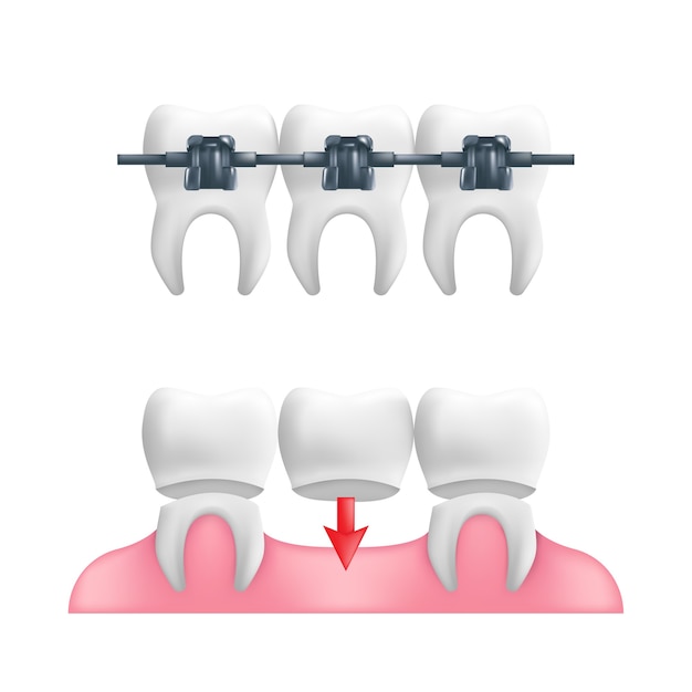 ベクトル 義歯の概念-固定された歯科用ブリッジワークとその上にブレースを備えた健康な歯。