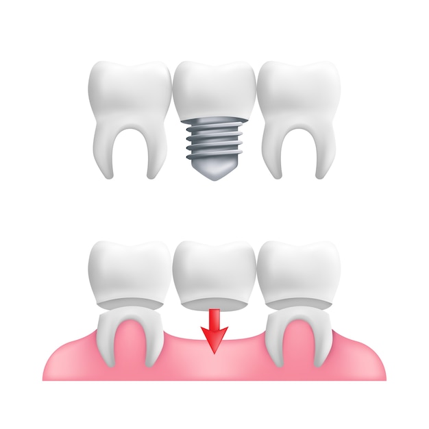 벡터 틀니 개념-고정 치과 교량 및 임플란트와 건강한 치아.