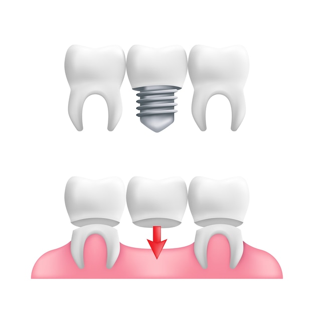 틀니 개념-고정 치과 교량 및 임플란트와 건강한 치아.