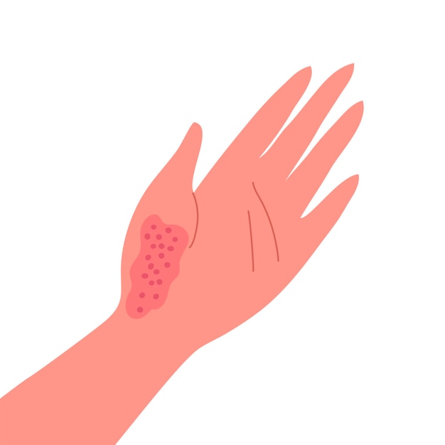 Dermatitis on the skin of a human hand