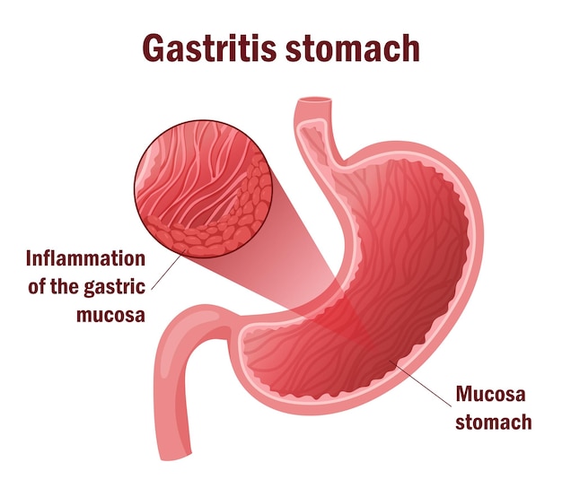 Detailed illustration cells inflammation in stomach