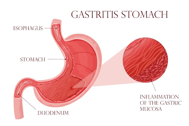 Detailed illustration inflammation in stomach