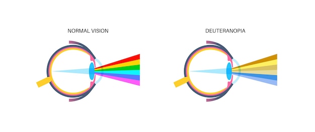 Deuteranomalia e deuteranopia