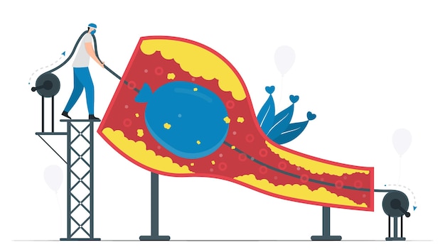 Deze ziekte is een vernauwing van de kransslagaders. ballon-angioplastiek wordt gebruikt om de bloedstroom van het vat te verbeteren. cardiologie vectorillustratie.