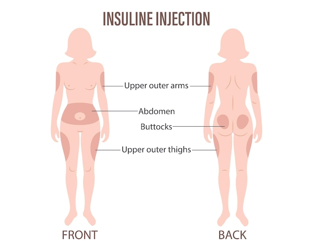 Diabetes Insulin injection sites on the human body upper arms abdomen buttocks upper thighs