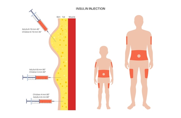 Diabetes treatment insulin injection sites on the human adult and child bodies flat vector