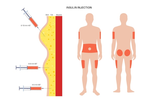 Diabetes treatment insulin injection sites on the human adult male body flat vector