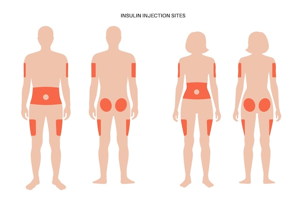 Лечение диабета Места инъекций инсулина на мужских и женских телах человека плоские векторные иллюстрации